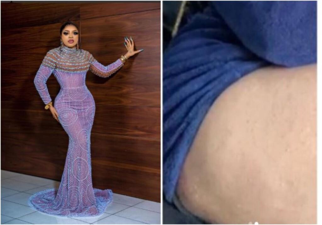 Photo of Bobrisky’s big lap with rashes covering his ‘yansh’ causes reaction on social media