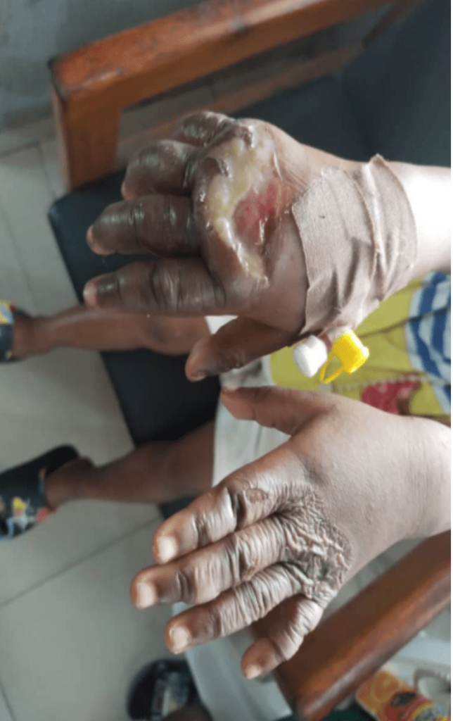 Mother puts five-year-old daughter’s hands in hot water for stealing fish in Cross River