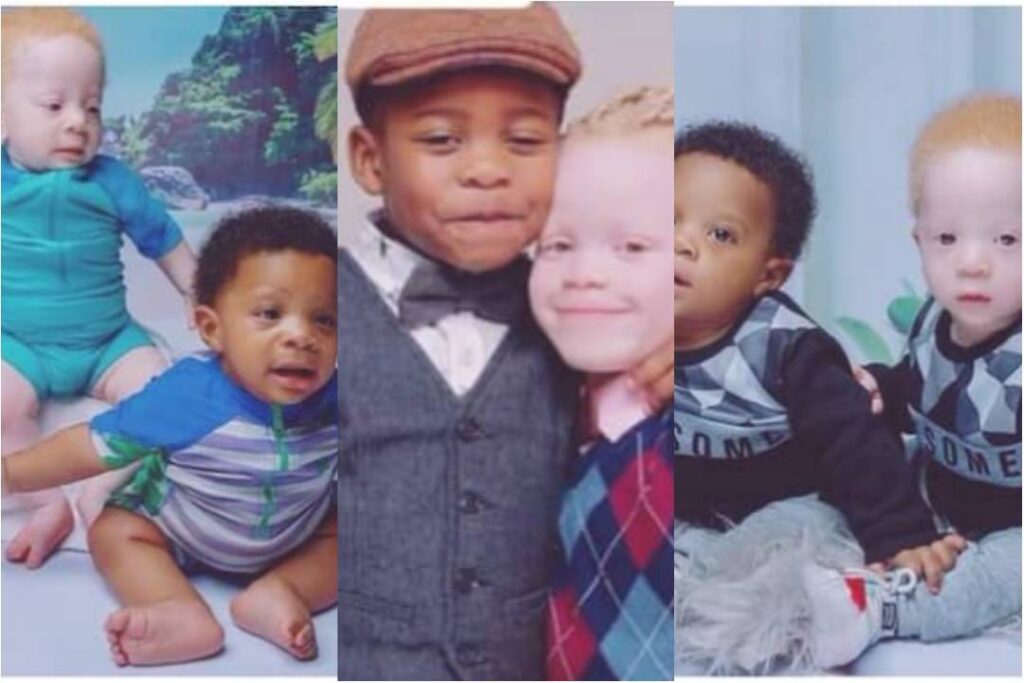 Rare Twins, One Black, and The Other One Albino Born by the Same Parents, with Their Beauty that Melts Hearts[video].