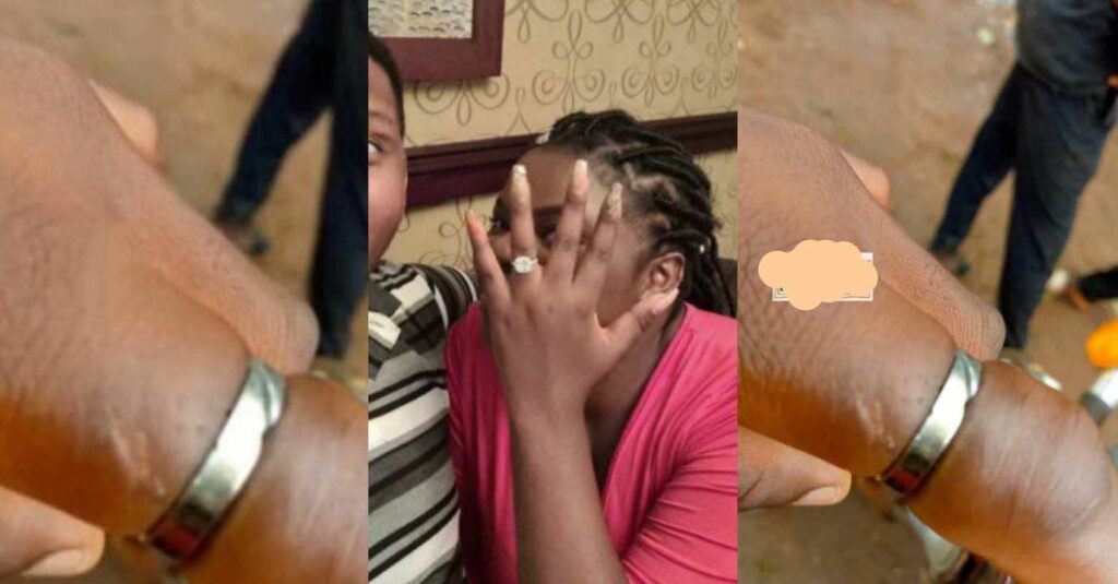 "Some Guys Doesn't Have Conscience" – See How Lady Almost Loses Her Finger for Wearing her fiance’s Engagement Ring For Over 12Years (Photos)