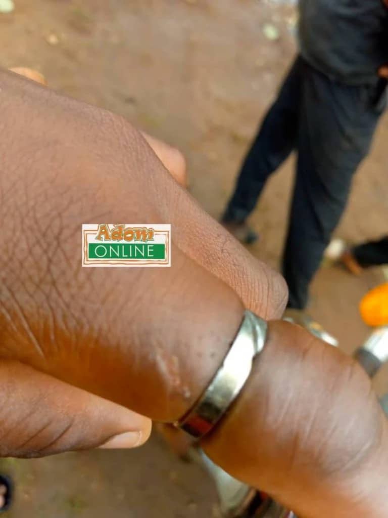 "Some Guys Doesn't Have Conscience" – See How Lady Almost Loses Her Finger for Wearing her fiance’s Engagement Ring For Over 12Years (Photos)