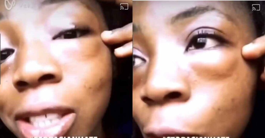 "Husband Wey No Sweet" – Beautiful Lady Reveals What Her Madam Did To Her Face and Body After Being Caught In Bed With Her Husband (Video)