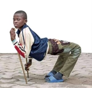 Nigerian Boy With Extreme Bow Legs Looks Totally Different After Undergoing Successful Surgery (Photos)