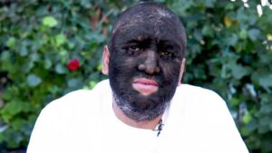 World’s Hairiest Man Has Hair Covering 98 Percent Of His Body(Photos)