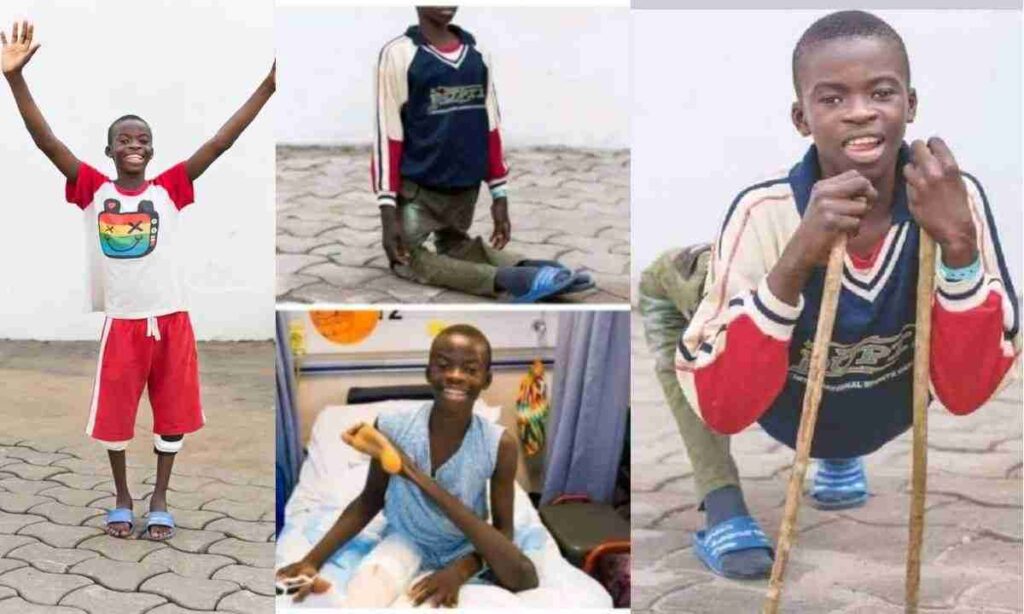 Nigerian Boy With Extreme Bow Legs Looks Totally Different After Undergoing Successful Surgery (Photos)