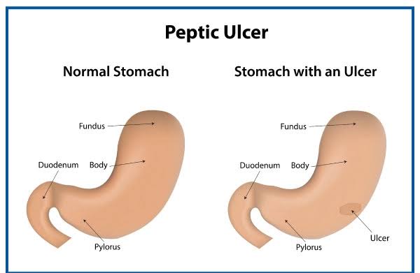 Hygienic food for Peptic ulcers patient