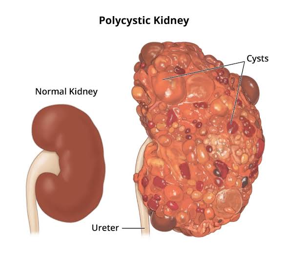 Kidney disease: All you need to know about it