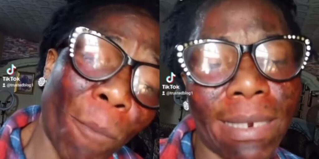 My husband’s side chic gave me acid as organic product for clean my face – Woman alleges